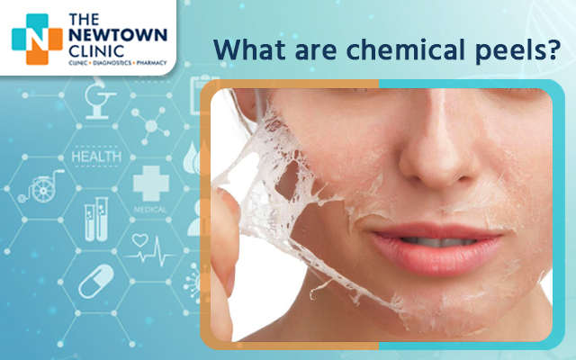 What Are Chemical Peels?