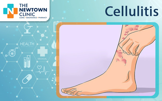Cellulitis symptoms