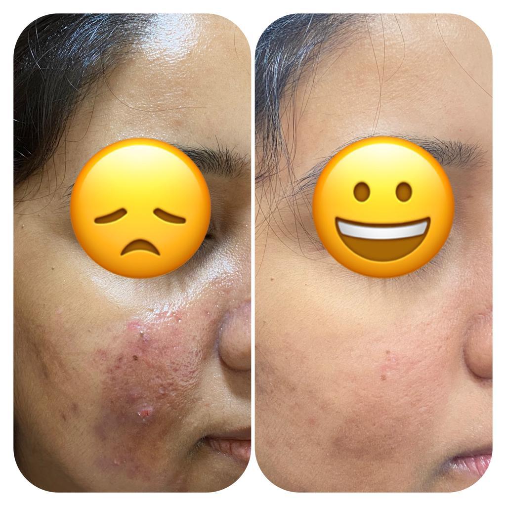 Treatment for Acne & Pigmentation