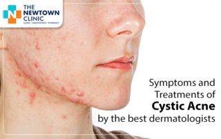 Symptoms and Treatments of Cystic Acne