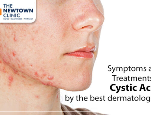 Symptoms and Treatments of Cystic Acne by the best dermatologists