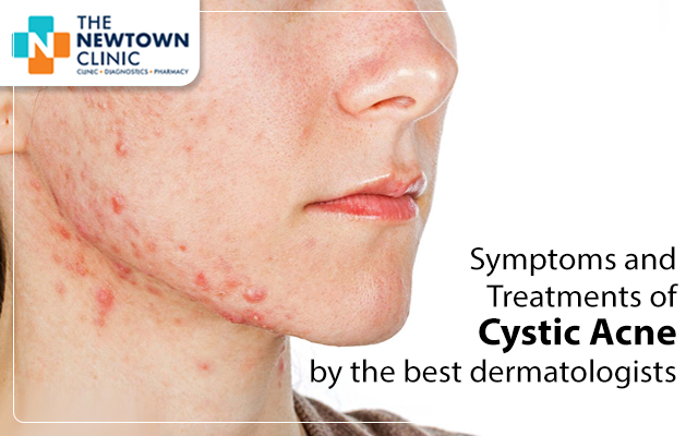 Symptoms and Treatments of Cystic Acne