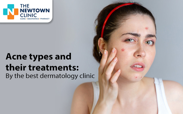acne treatment in newtown