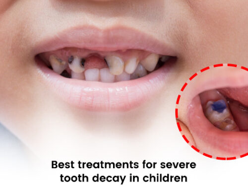 Best Treatments for Severe Tooth Decay in Children by The Newtown Clinic