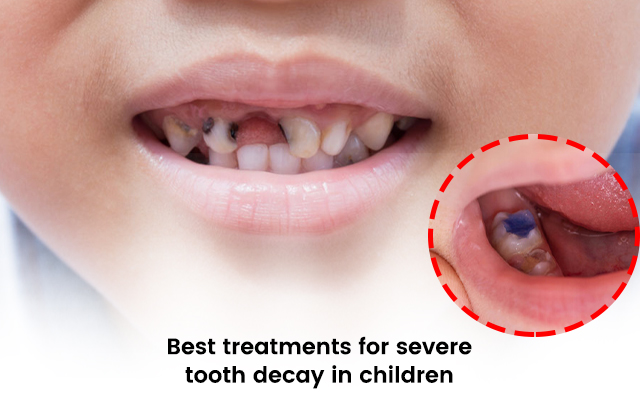 tooth decay treatment in newtown clinic