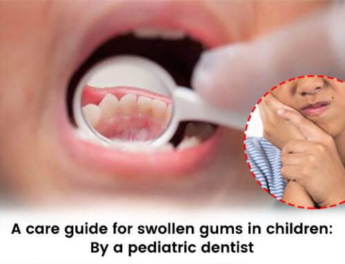 A care guide for swollen gums in children: By a pediatric dentist