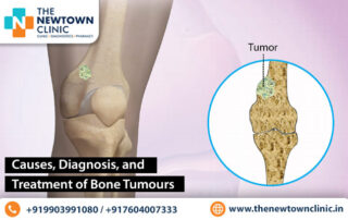 Bone Tumours Treatment