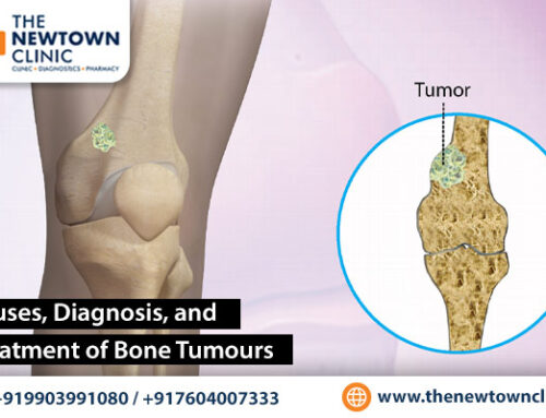 Causes, Diagnosis, and Treatment of Bone Tumours