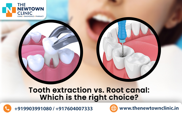 Tooth extraction and root canal