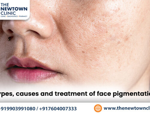 Types, causes and treatment of face pigmentation
